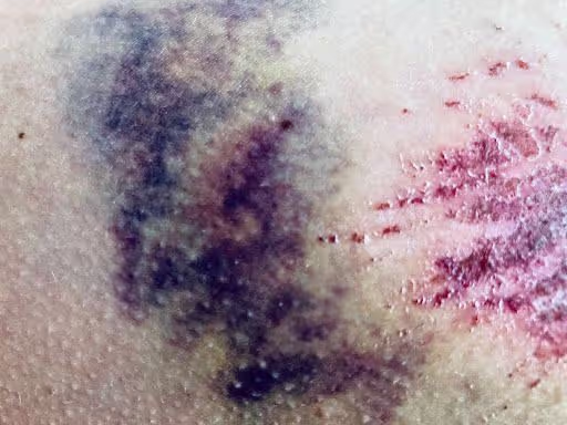 Ferita <l-m>mill-qrib</l-m>.